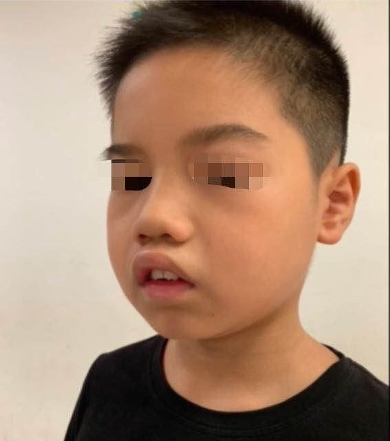 孩子腺样体面容的6个信号,家长务必关注!