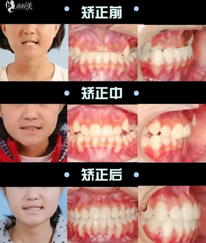 四医大口腔医院冯雪医生早期干预地包天矫正案例