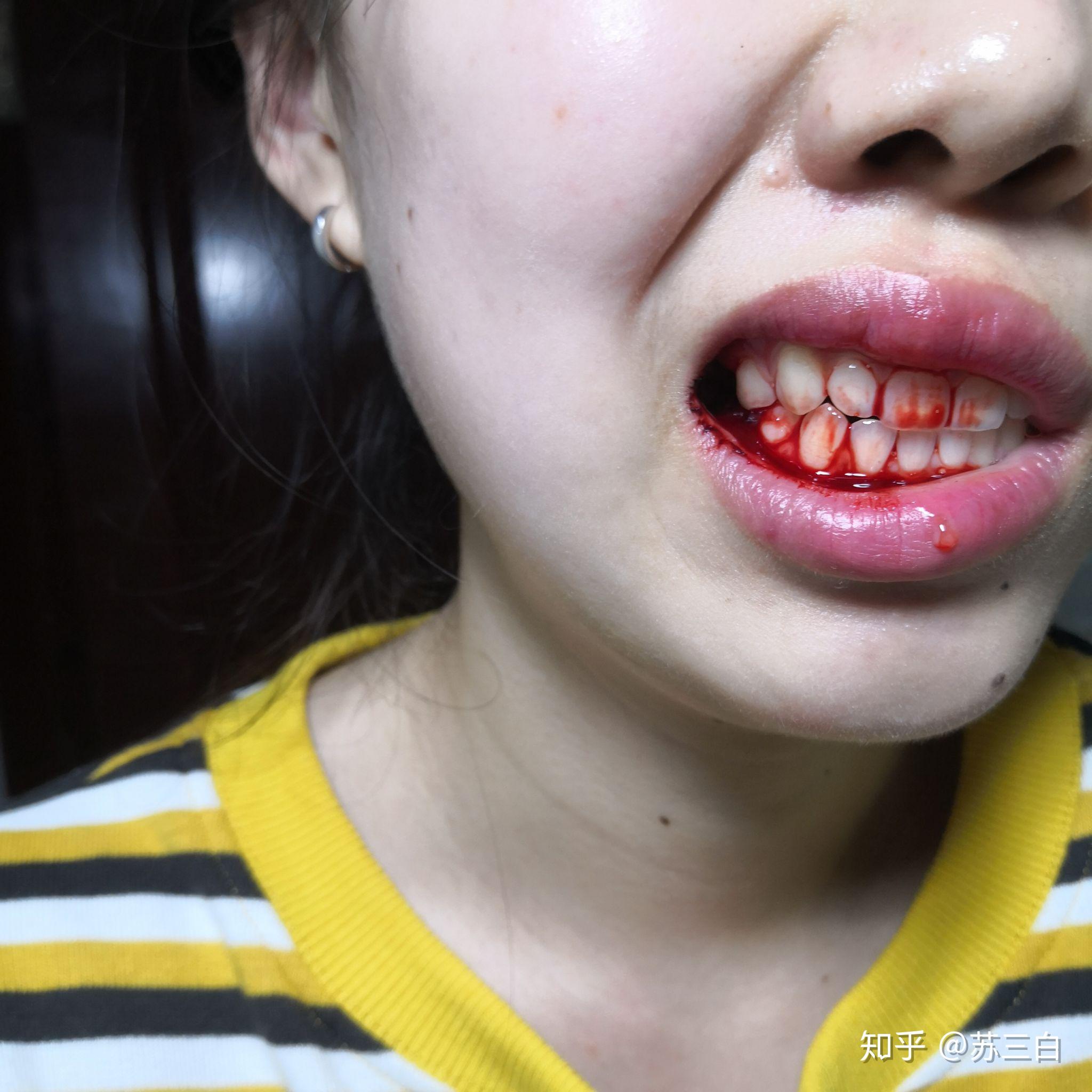 骨性嘴凸牙齿矫正上海口腔病防治院