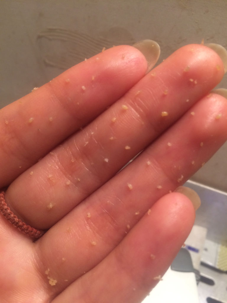 脸上长的这是什么东西,挤出来就是一个硬颗粒,各位护肤专家帮我看看