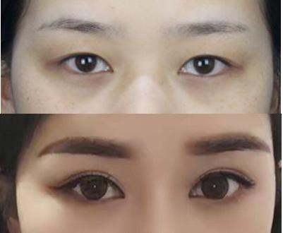这5种眼睛不做双眼皮,会很难看!
