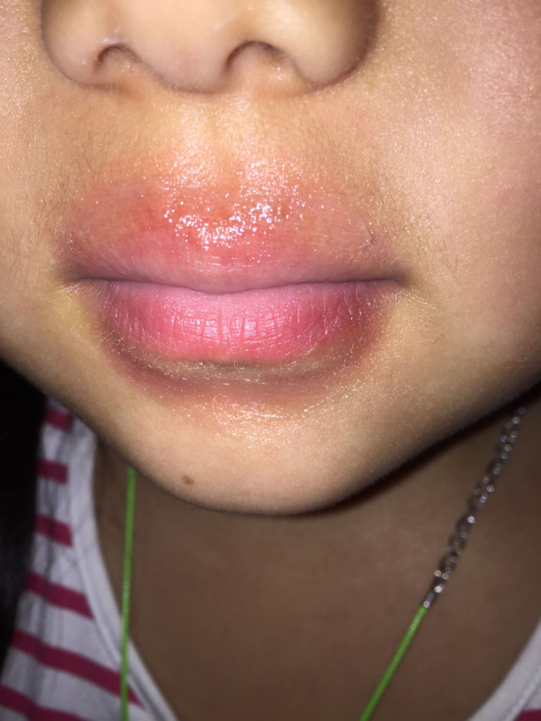 孩子的嘴唇这是怎么了?三天两头这样,这是病吗?刚给抹了点油