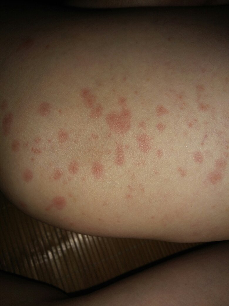 在高温环境下工作,今天下班,身上陆陆续续起满了红斑点,是什么原因