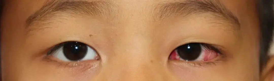 儿童眼病郭新教授西安限时坐诊手术,斜弱视等眼病患者速预约!