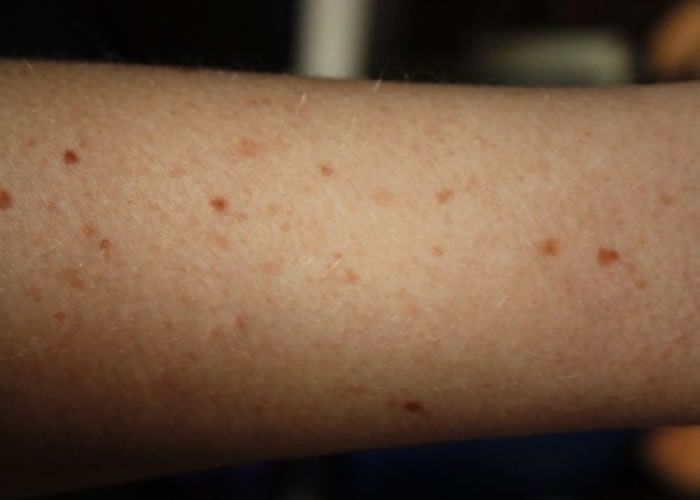 癌症早期皮肤症状图片_皮肤癌早期症状图片_癌症早期的图片