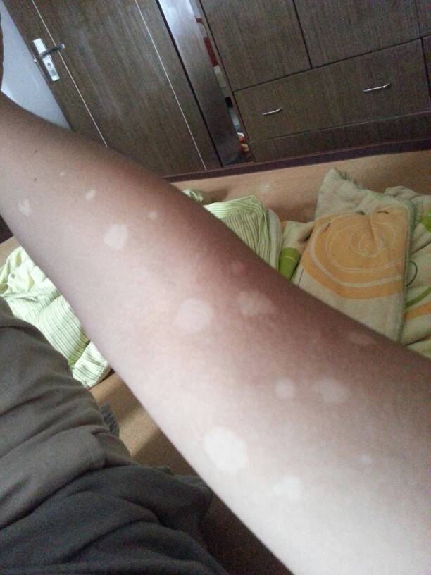 这是汗斑么?用什么治疗_百度知道