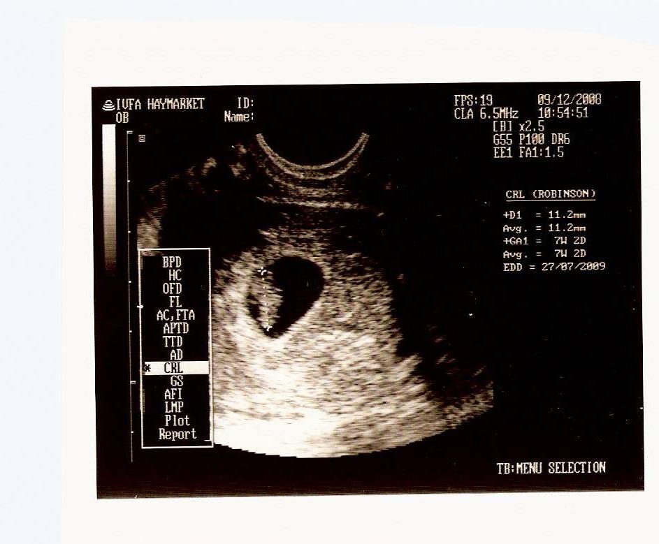 教你孕囊看男女不是不准是你不会看只图个乐子