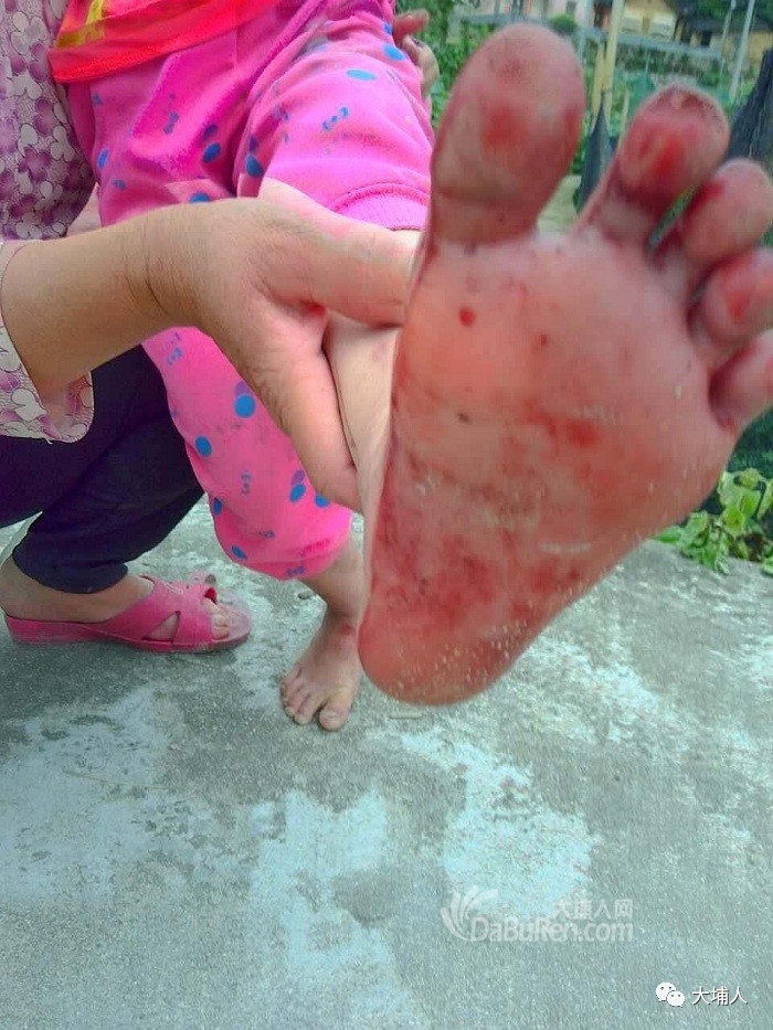 大埔一小学内施工5岁小孩和村民遭铁钉扎脚