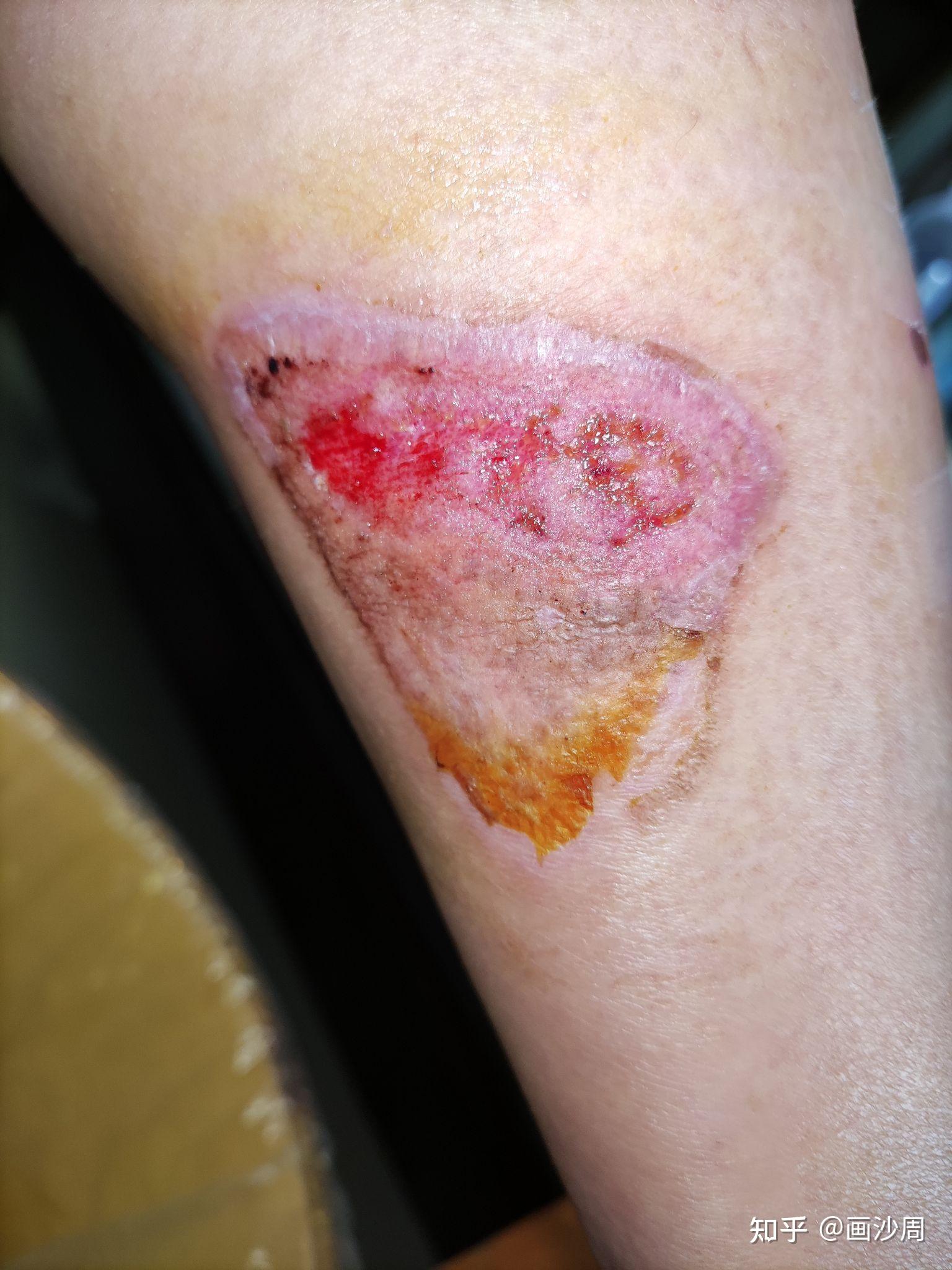 记录摩托车烫伤三度恢复过程 - 知乎