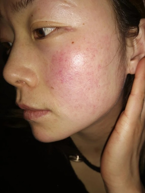 什么是红血丝 面部为什么会有红血丝?