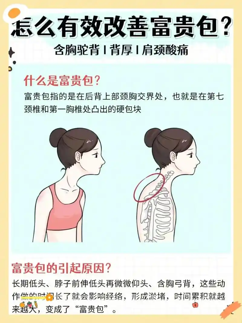 打造气质好体态.如何消灭富贵包?打造气质好体 - 抖音