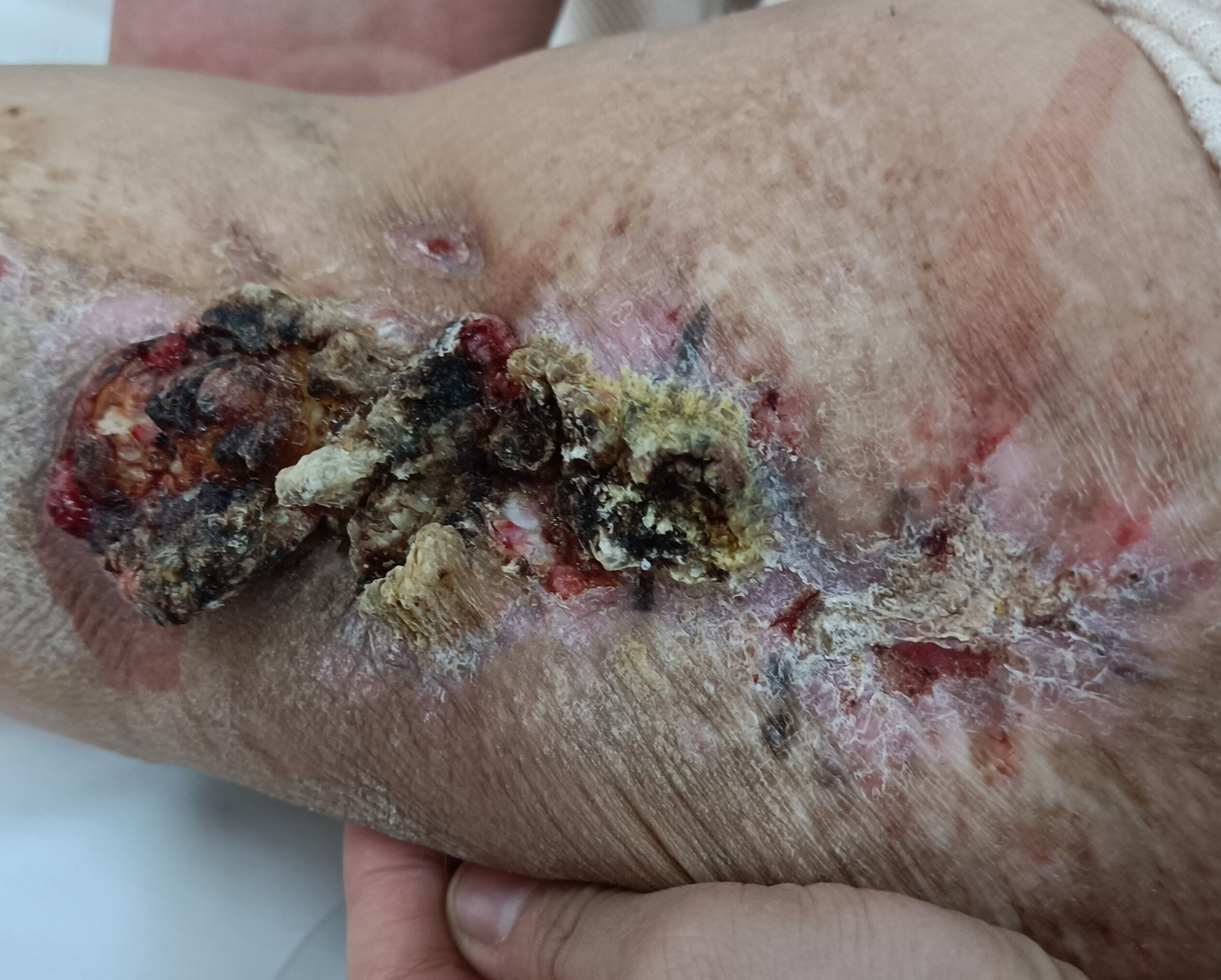 浅谈婴幼儿血管瘤