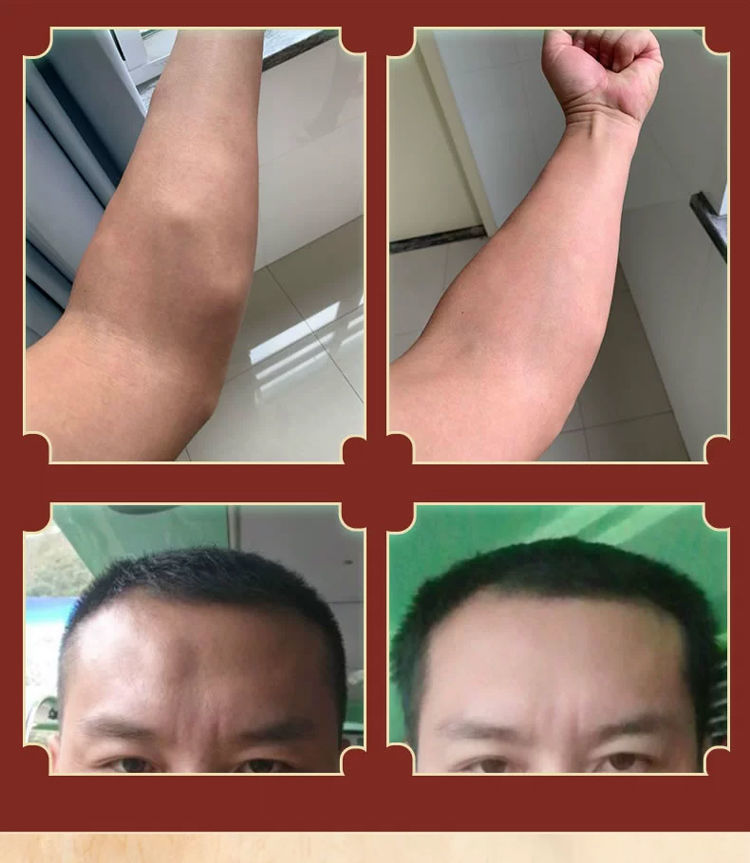 一贴见效脂肪瘤克星延安苏季善效万秋堂脂肪瘤去除膏消贴专用去除皮下