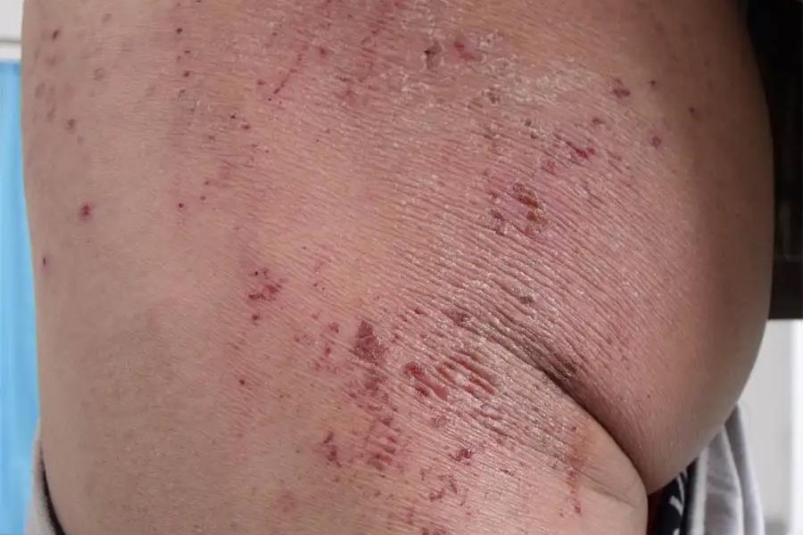 腹股沟湿疹和股癣的区别图片