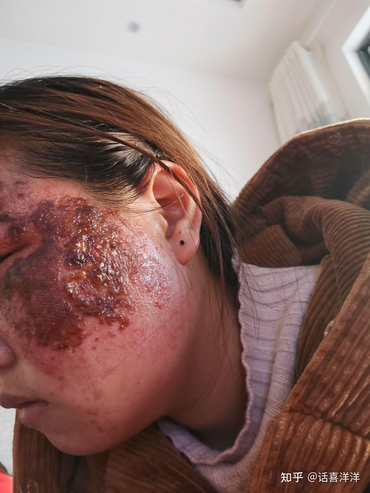 热油烫伤面部记录