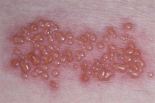 带状疱疹传染吗