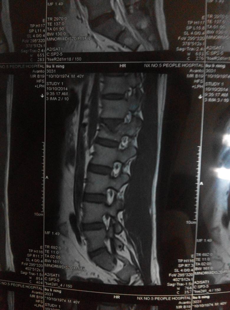 我腰椎第一节压缩性骨折第四天能左右翻身下地行走