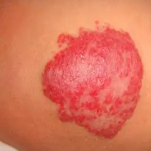 患上血管瘤的症状有哪些