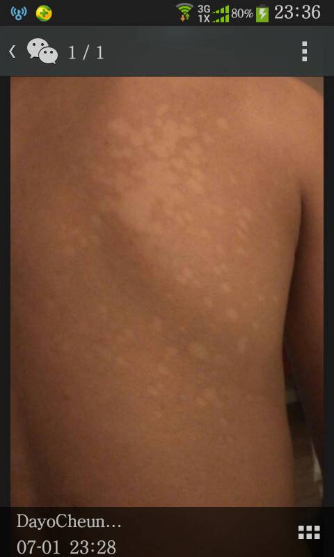 背后长白斑,快两个月了,不疼不痒的!很苦恼,好像越来越多了!