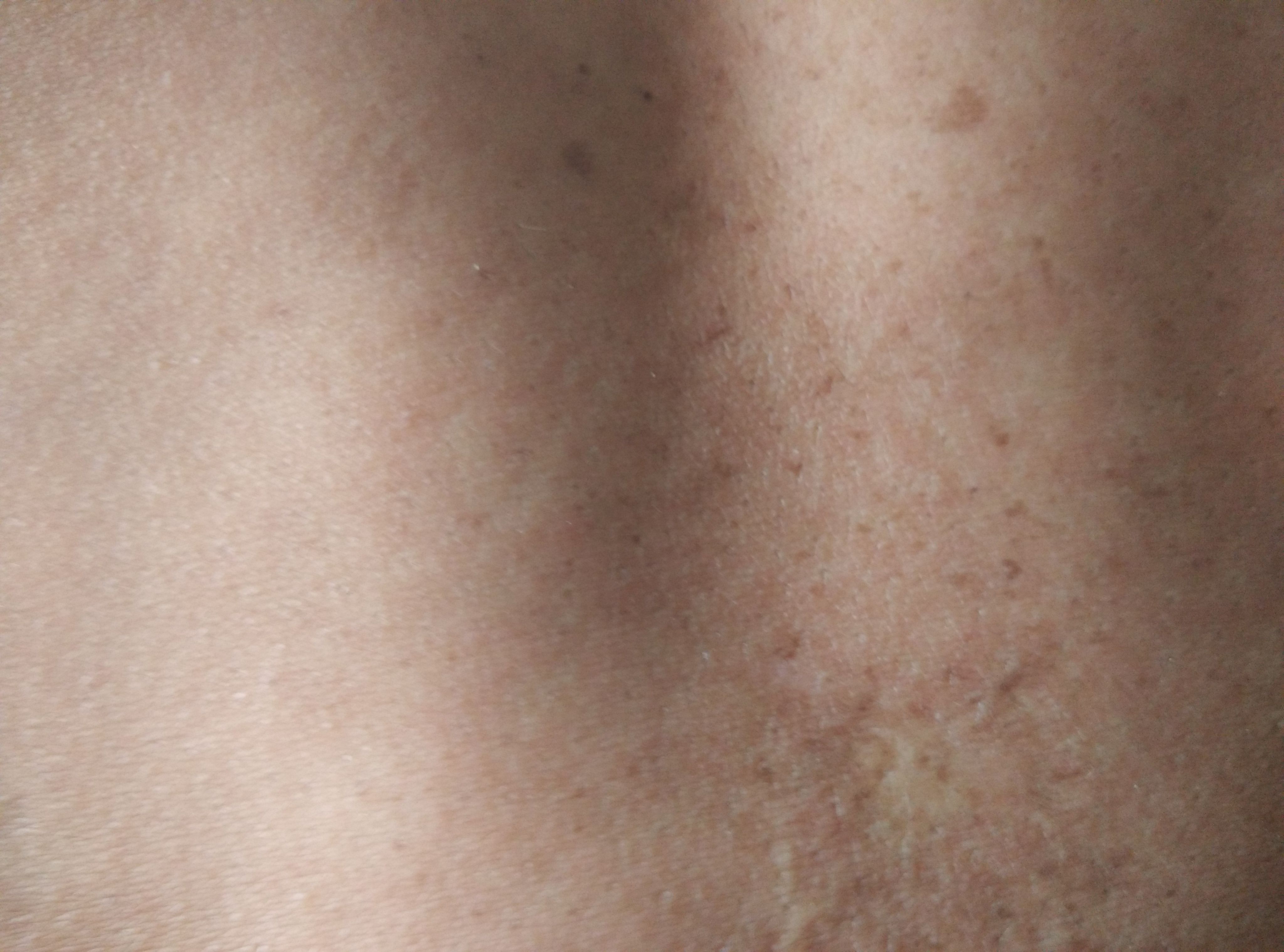 发布于2015-06-26 12:35   最佳答案 有可能是花斑癣,建议去医院