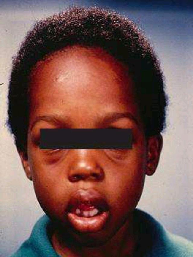 "腺样体面容"怎么预防和处理?