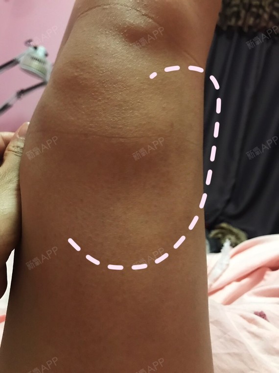 右腿凹陷明显…… 凹陷侧面明显右腿～～92_圈子-新氧美容整形