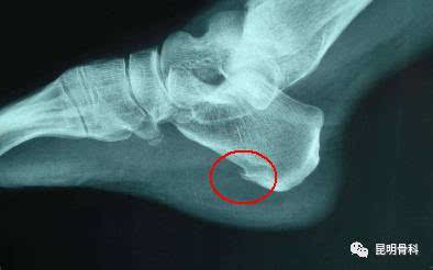 "骨刺"是不是一定要去掉呢?