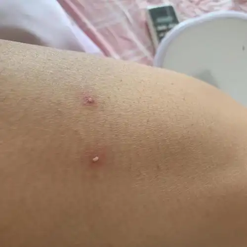 干性湿疹演变成脓包型的了01