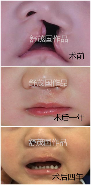 单侧完全唇裂手术治疗