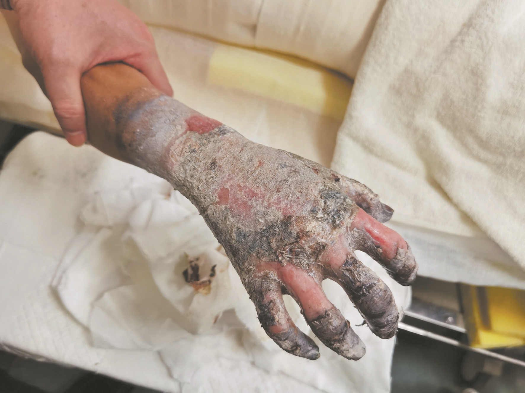 打3份工的家庭顶梁柱被人点火烧伤 巨额医疗费难住一家人 盼好心人伸