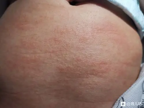 求助宝妈,8个月的宝宝起了很多红点怎么办?