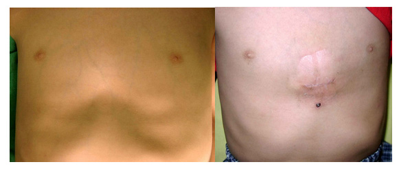 漏斗胸与鸡胸的治疗