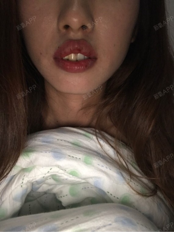 我牙骨突出上嘴唇外翻并且上下嘴唇都很厚正常情况是闭合不了的笑起来
