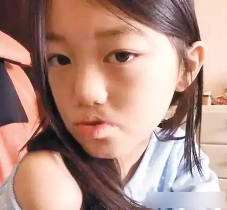 王菲女儿李嫣兔唇原因分析李嫣兔唇修复后最新照片