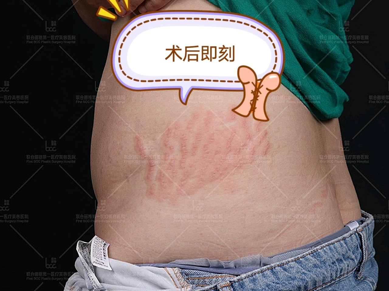 妊娠纹治疗术后第1天