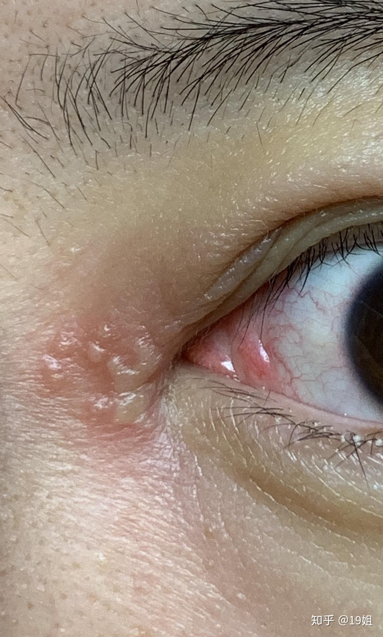 左边内眼角皮肤起水泡怎么办