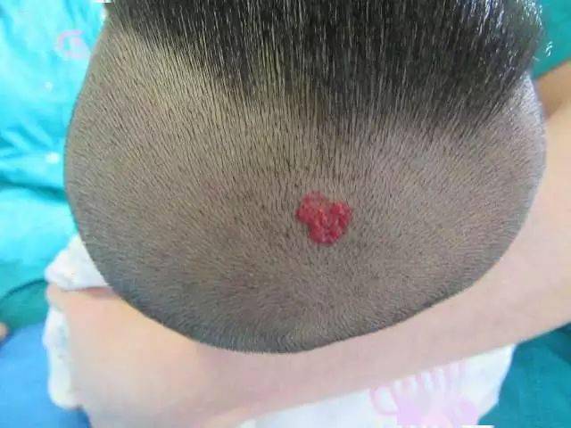 科普| 2种头部毛细血管瘤 您可要当心!