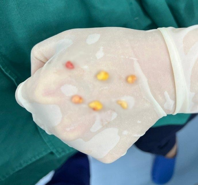 你别看眼袋小小的,里面的脂肪并不少