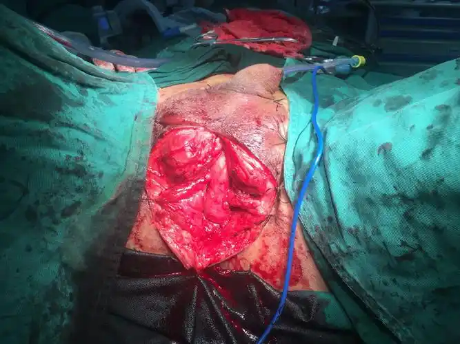 骨盆骨折后尿道狭窄尿道吻合术