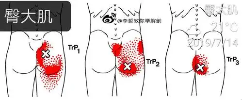 臀大肌 gif 腹直肌 急性腰椎疼痛的人是不建议直接去按摩腰部的肌肉