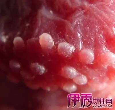 【图】男性珍珠疹初期图片大透露 小编更揭秘