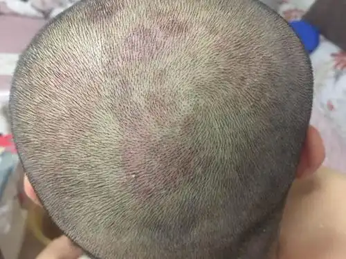 求证!什么是体癣"智慧管理"-第1张图片-米兔博客