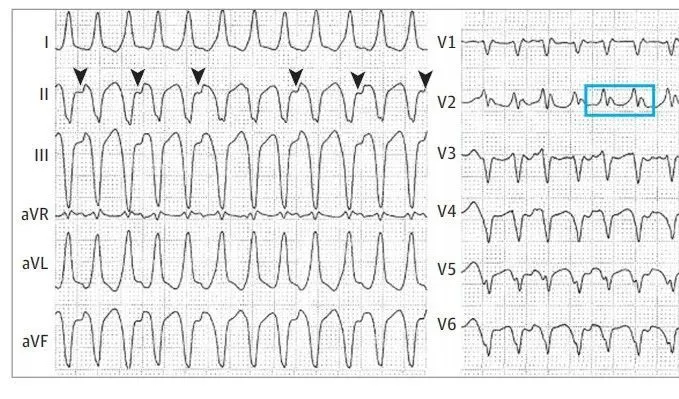 从患者的心电图来看,呈现宽qrs心动过速,胸导联的qrs波的几乎一致负向