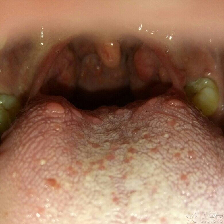 如题,舌根部长了好多个扁平凸起,会是扁平疣长到舌头上了吗?