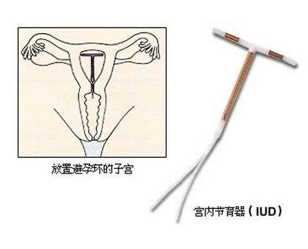 上环的副作用上环的最佳时间哪些人不宜上环