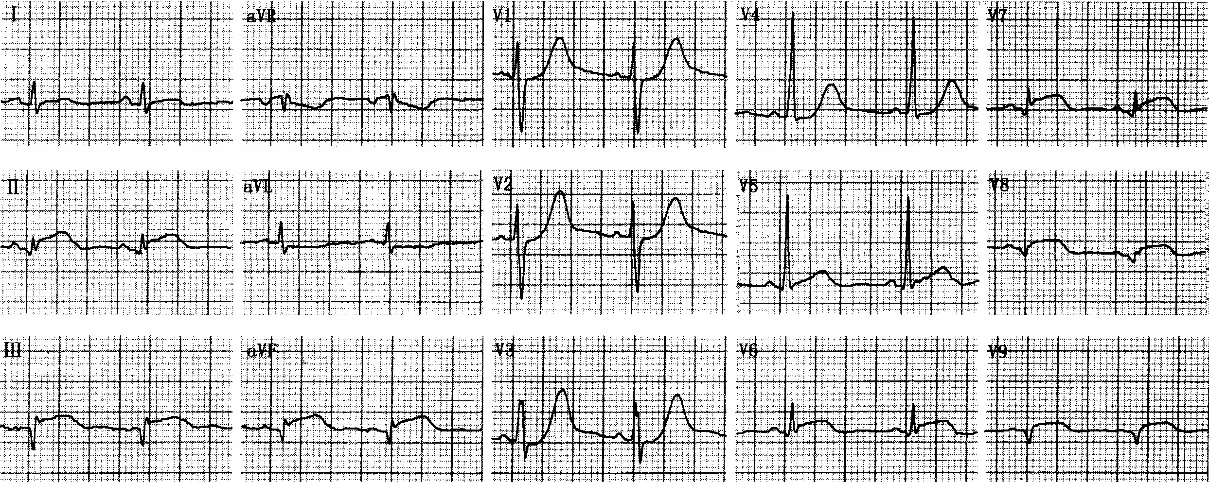 4 正后壁心肌梗死-心电图临床实习-医学