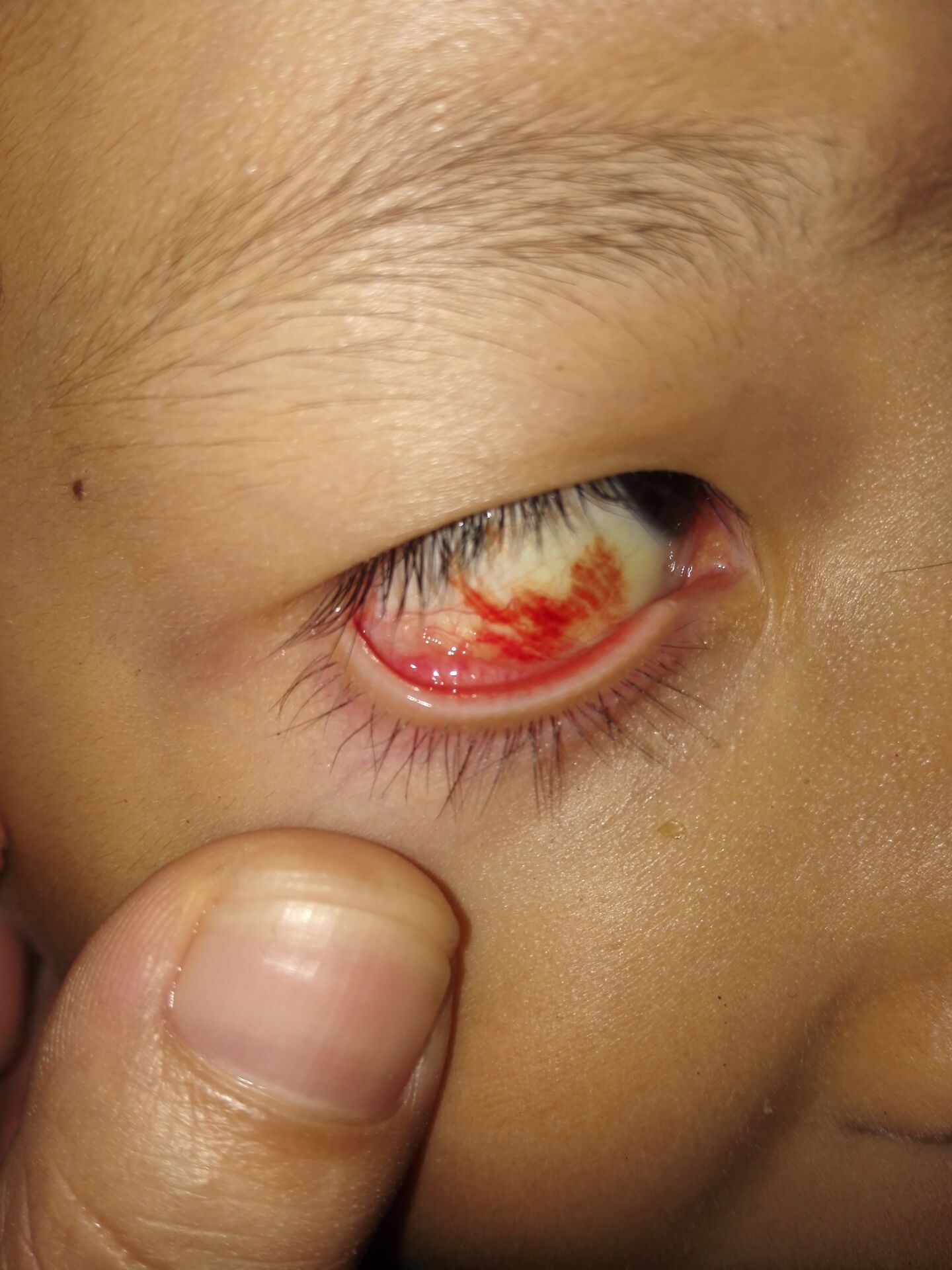 6岁的女孩眼睛里有一块红色的吓死我了!是怎么回事?