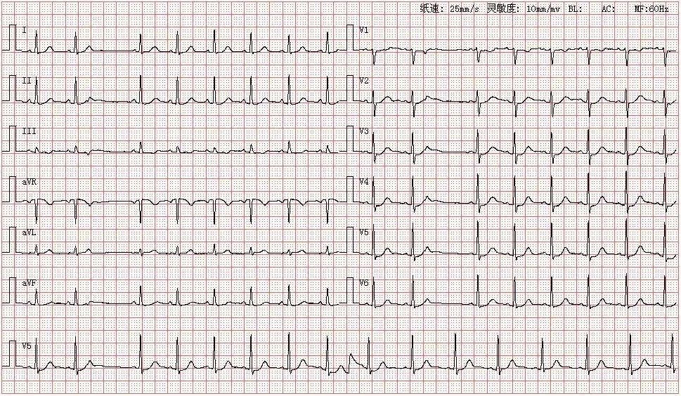 患者女,25岁,图为其产检心电图结论:窦性心律房性早搏未下传分析:分析