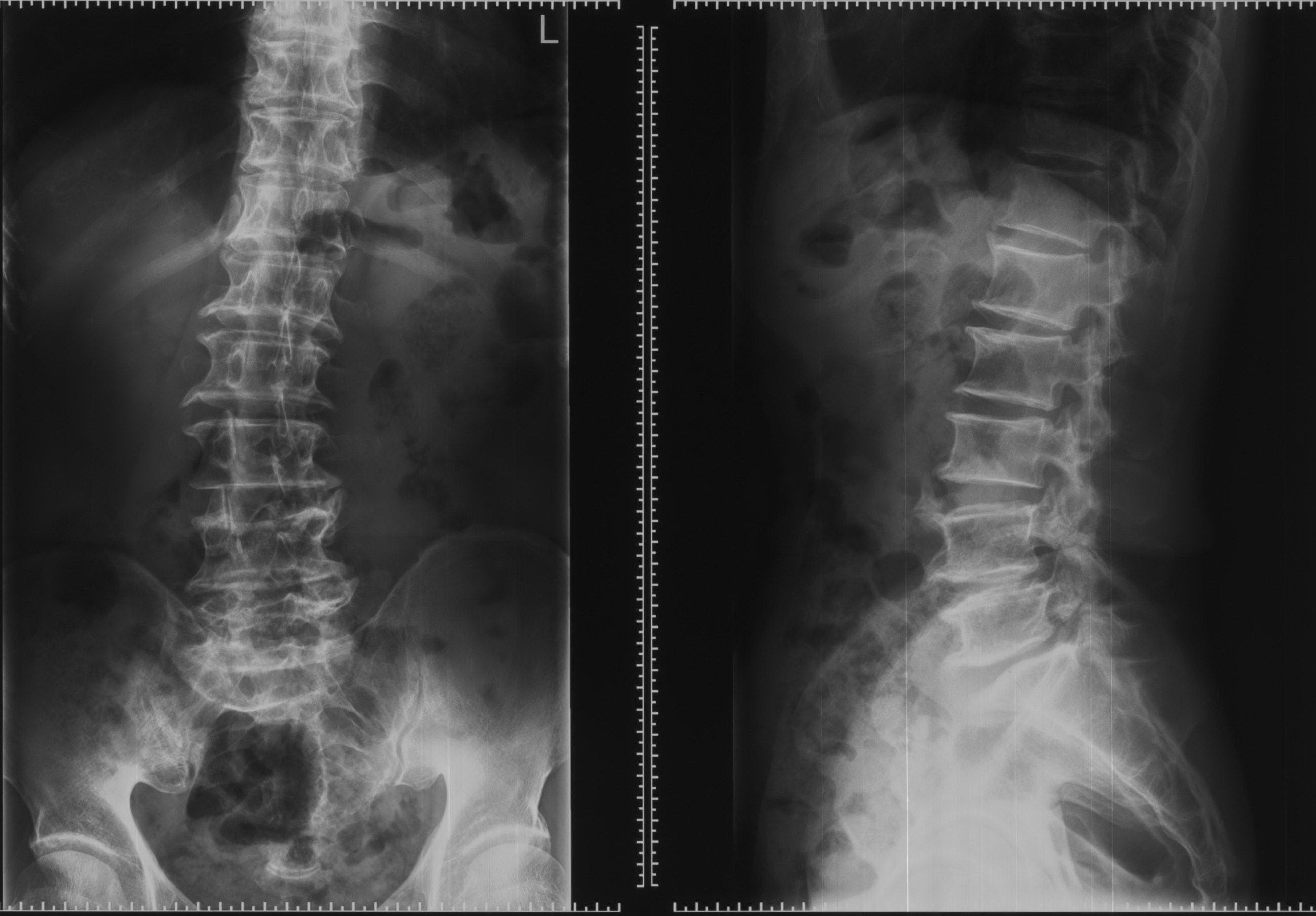 腰椎间盘突出症的症状,检查及治疗_腰椎间盘突出_症状表现_检查_治疗