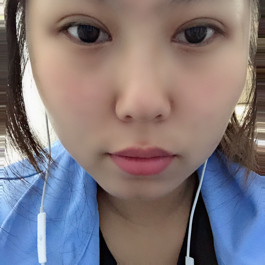 割双眼皮1个月零25天,是不是太窄了,会不会变内双